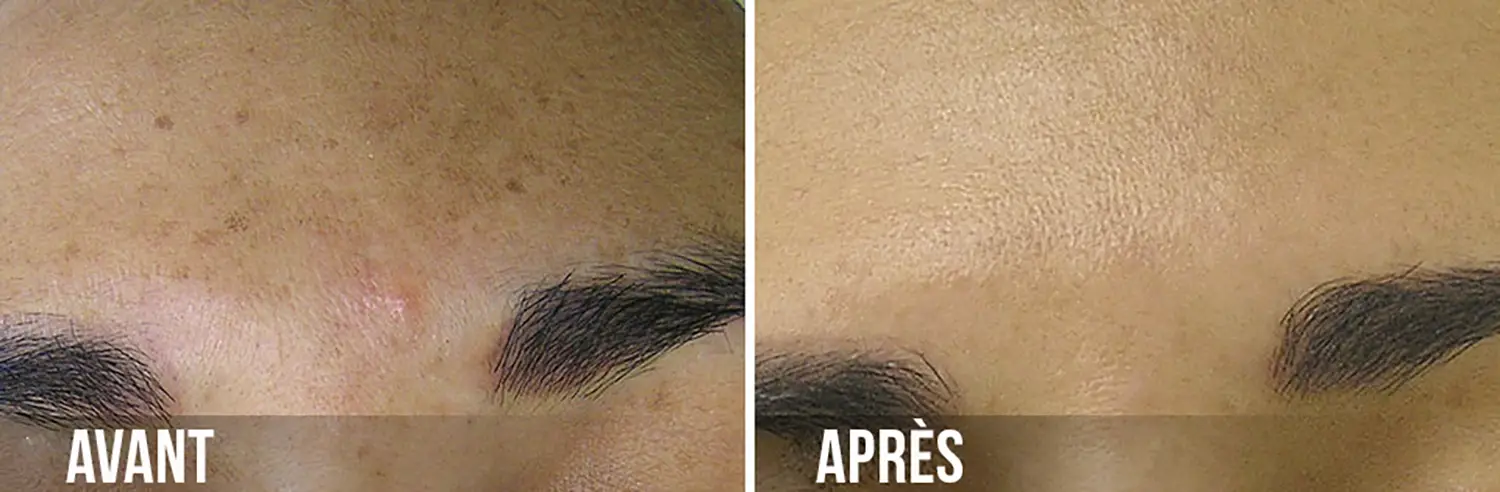 before & after brown spots